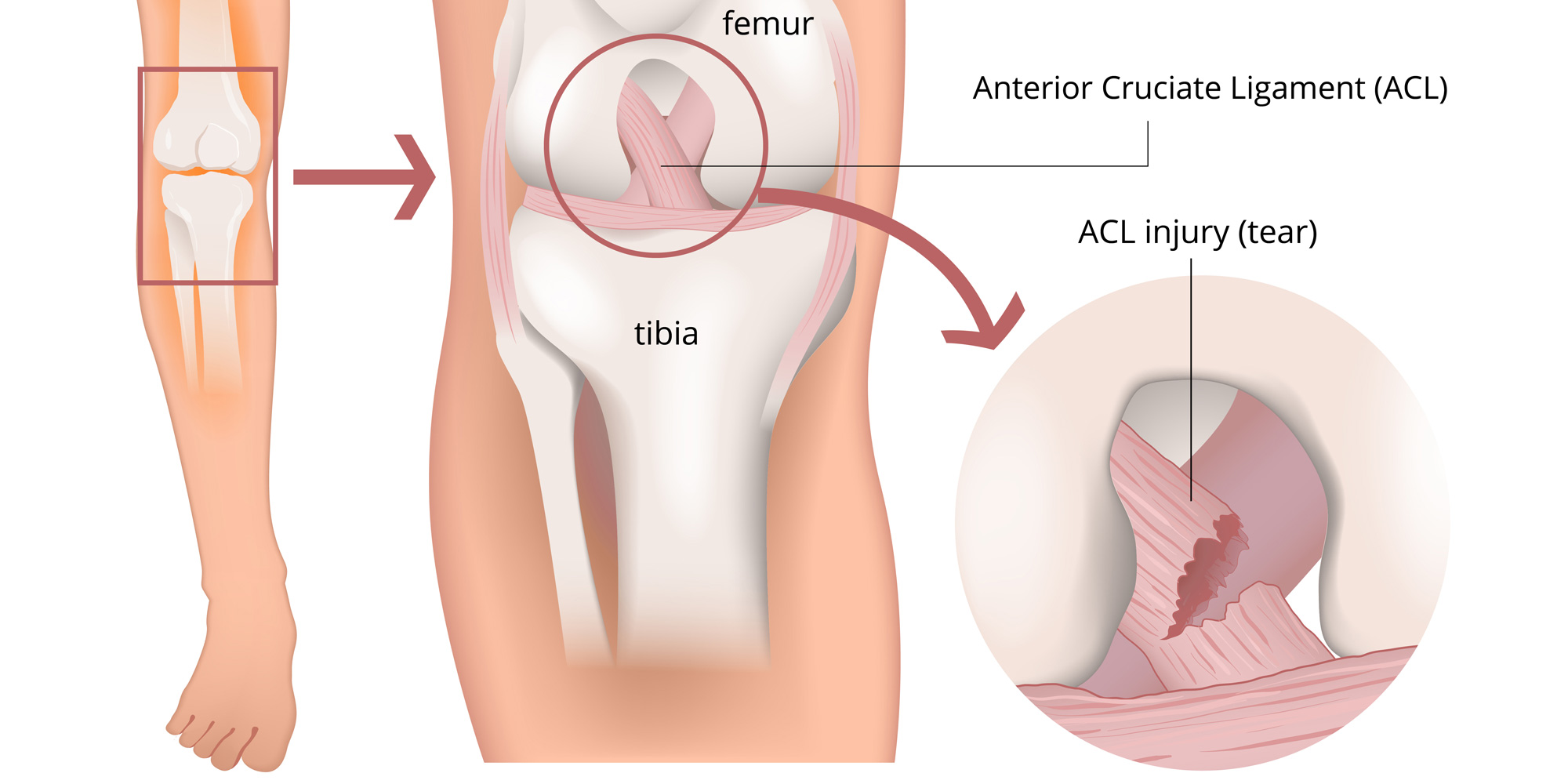 ACL-Injury