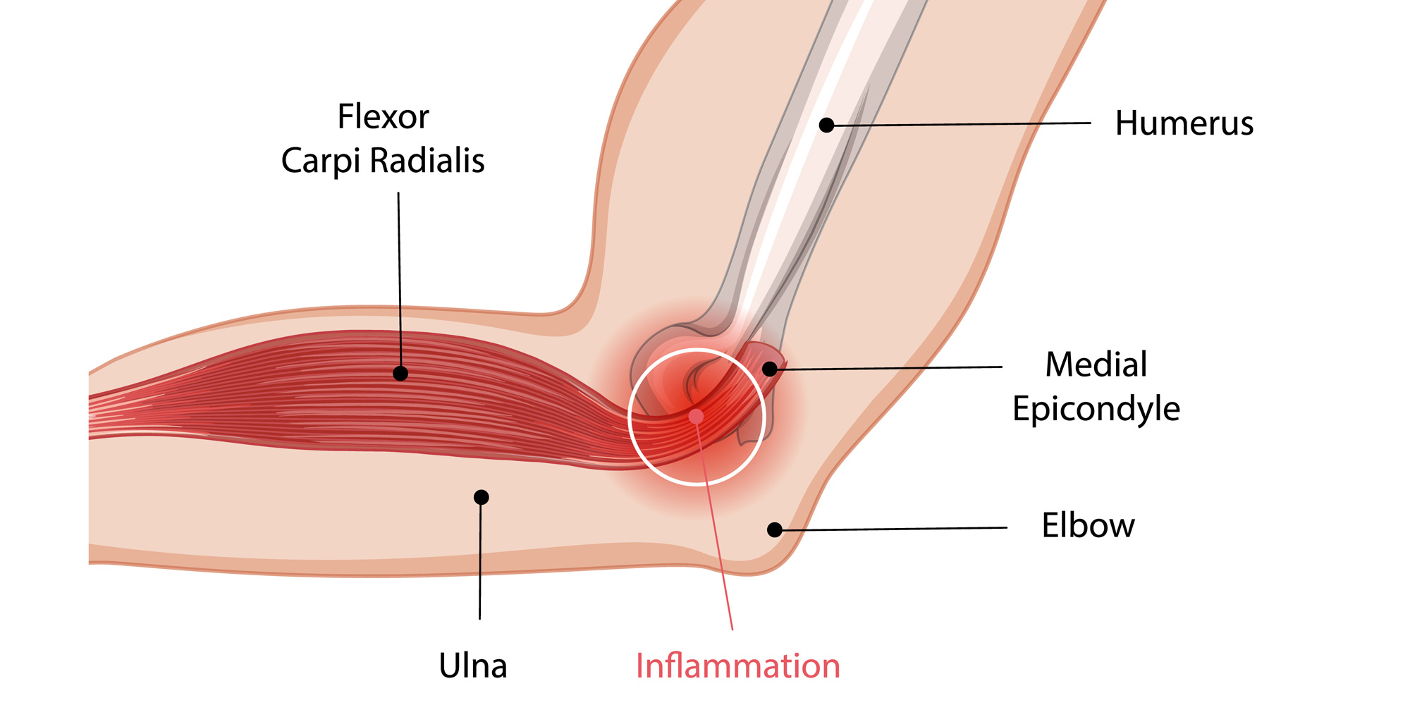 Golfers-Elbow
