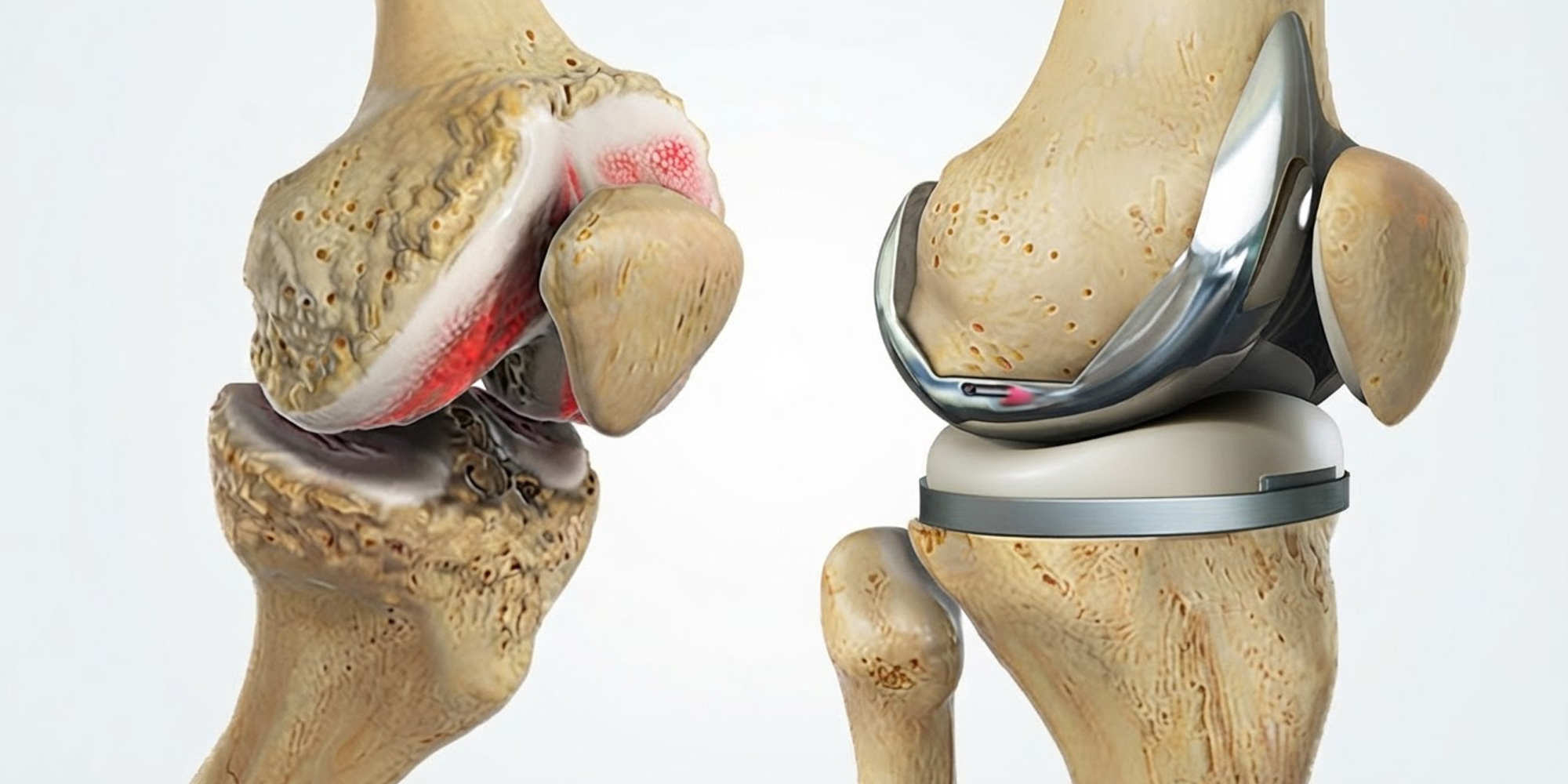 Knee-Replacement