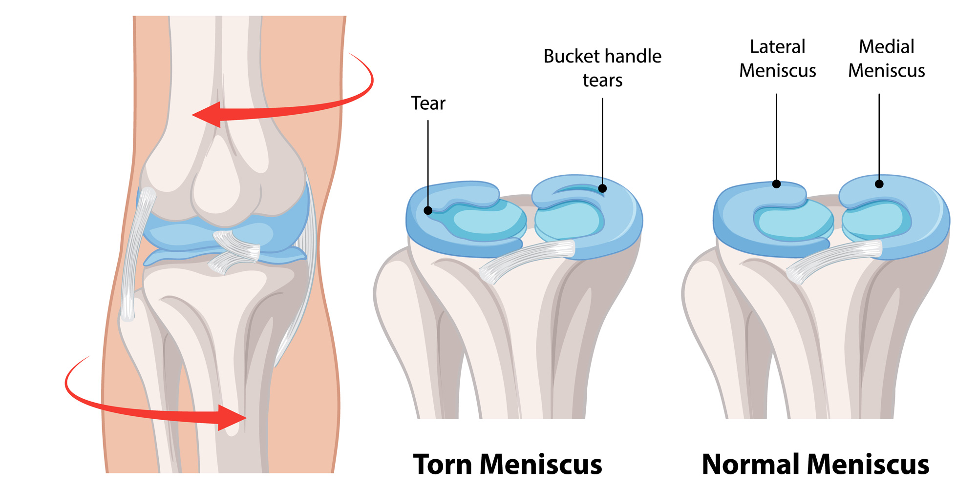 Meniscus-Tears