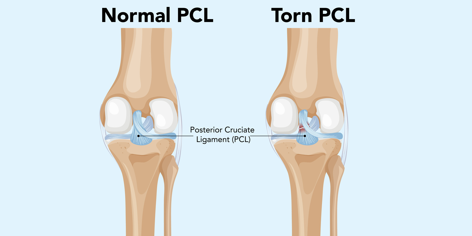 PCL-Injury