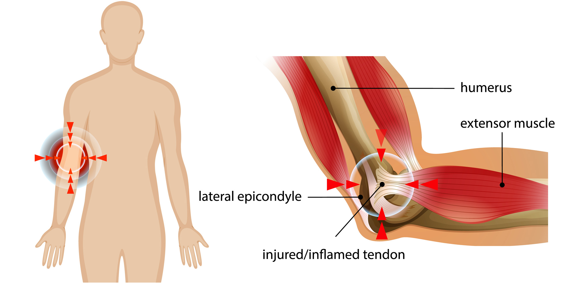 Tennis-Elbow